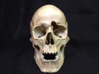 Human Male Skull with Gunshot Wound
