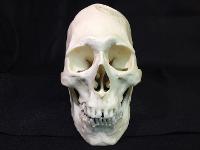 Peruvian Male Skull with Cranial Binding and Trephination