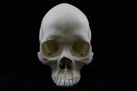 Human Female Skull with Scaphocephaly